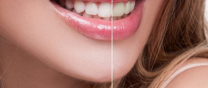 The Best Dental Crowns in Houston